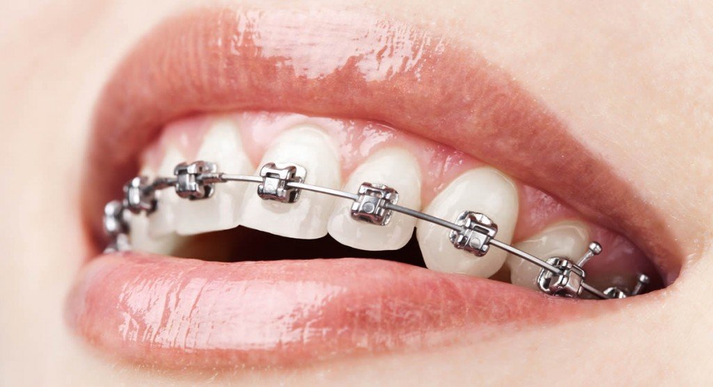 Ortodontie (aparate dentare)